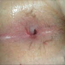 Check spelling or type a new query. Thrombosed External Hemorrhoid Diameter 15 20 Mm With A Black Clot Download Scientific Diagram