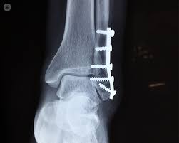 Sep 21, 2021 · nba 2k17 ankle breaker badge guide: Broken Fractured Ankles Faqs Answered By A Specialist Top Doctors