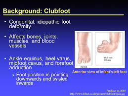 Doctors don't know what causes it, and. Baby Bootie Clubfoot Orthotic Device Ppt Download