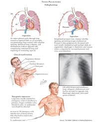 Image result for Open Pneumothorax