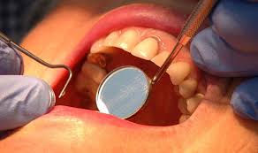 Often, the earliest sign of the presence of mouth cancer is a change in the way the mouth looks. Surgeons Warn Of Delayed Mouth Cancer Diagnosis Due To Dentist Referrals Express Co Uk
