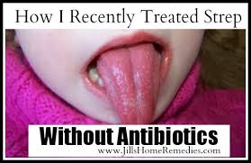How I Recently Treated Strep Without Antibiotics Strep Throat Remedies