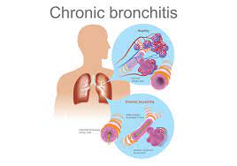 Chronic Bronchitis – Pulmonary Practice