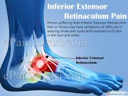 Next to the tibia is the fibula, Inferior Extensor Retinaculum Pain Causes Symptoms Treatment