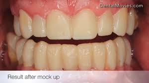 Wax Up And Mock Up Treatment Planning Youtube