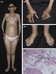 Image result for Lipodystrophy