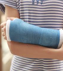 Image result for Radial Gutter Cast