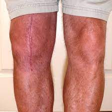 Possible Knee Replacement Surgery Complications