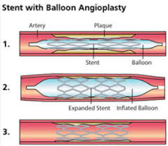 Most angioplasty procedures do not require an overnight stay. Balloon Angioplasty Stenting Vascular Care Centre