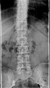 Check spelling or type a new query. Transverse Process Fracture Receiving