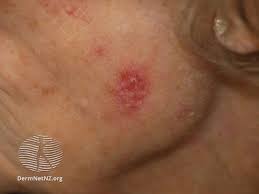 Skin cancer can spread to and damage nearby the american academy of pediatrics approves of the use of sunscreen on babies younger than 6 months old if signs of advanced, aggressive or neglected skin cancer may include Skin Cancer Image Gallery Pictures And Photos