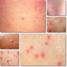 Applicate una leggera pressione sulla pelle e iniziate ad effettuare dei movimenti avanti e indietro. Puntini Rossi Sulla Pancia Cause Sintomi E Cura Vitamineproteine Com