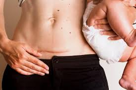 Mempertahankan berat badan yang sehat adalah upaya yang harus dilakukan seumur hidup. Cara Sehat Menurunkan Berat Badan Setelah Operasi Cesar Womantalk