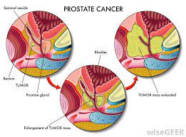 It's essential in producing fluid that enriches semen, but it may cause issues as. What Are The Most Common Causes Of Prostate Swelling
