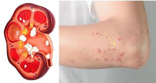 11 Kidney Damage Symptoms Most People Ignore Kidney Failure Symptoms Kidney Disease Chronic Kidney Disease