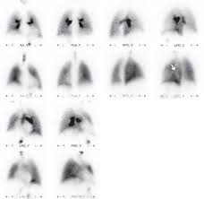 Image result for Ventilation Perfusion Scan