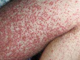 Purpura or purpuric rashes are also caused by bleeding in the intradermal layers of the skin. Purpura Vs Petechaie Differences Causes And Treatments