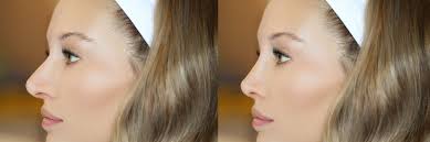 Hear from top experts in the field of Rhinoplasty