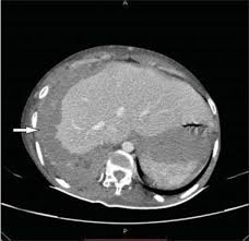 We did not find results for: Malignant Pleural And Peritoneal Mesothelioma Consequential To Brief Indirect Asbestos Exposure Journal Of Clinical Imaging Science