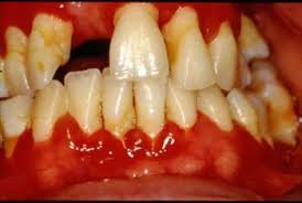 Plaque is a sticky substance that contains bacteria. Gingivitis Mouth And Dental Disorders Msd Manual Consumer Version