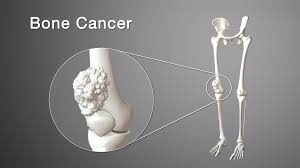 This gradually progresses to a persistent ache or an ache that comes and goes, which continues at night and when resting. Bone Cancer Types Symptoms Causes And Treatment Scientific Animations