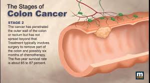 Bowel cancer usually develops from a small fleshy growth (polyp) which has formed on the lining of if the cancer is diagnosed when it has grown through the wall of the colon or rectum, or spread to. 0 4 Stages Of Colon Cancer Primrose Ngwende Cancer Trust Facebook
