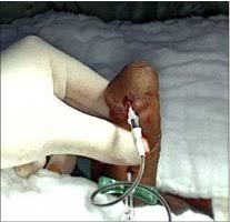 Image result for Priapism