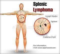 Lymphoma treatment may involve chemotherapy, immunotherapy medications, radiation therapy, a bone marrow transplant or some combination of these. Splenic Lymphoma Causes Symptoms Treatment Prognosis