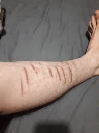Daily cleaning is generally necessary to prevent infection and a doctor or nurse will show you how to clean and redress your wound. Same On Other Leg 56 Stitches Collectively Cost Me My Job 7 Months Clean On Every Self Harm I Did Keep Fighting The Good Fight Selfharmscars
