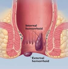 People whose cancer is diagnosed at an early stage have a much higher chance of successful treatment than bright red blood may come from swollen blood vessels (haemorrhoids or piles) in your back passage. What Is A Hemorrhoid What Are The Types Causes Symptoms