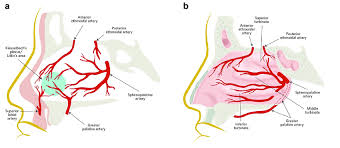 Image result for Epistaxis