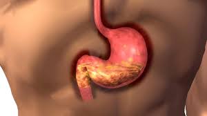 Atrophic gastritis is a form of chronic gastritis that causes a gradual loss of gastric glandular cells, which are replaced with intestinal and fibrous tissues. So Fies Ist Die Chronische Gastritis