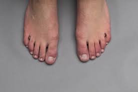 Do you have a swollen toe? What Are Covid Toes Mydr Com Au