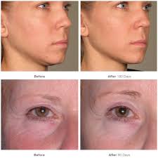 The vast majority of people who get tefl/tesol certified to teach english abroad or virtually earn their certificates online, and this type of certification is accepted by most language. Should You Be Afraid Of Ultherapy Review Side Effects And Cost