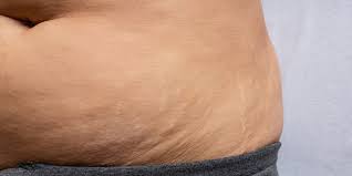 Jedoch ist es nach einer schwangerschaft erstmals wichtig den hauptfokus eines trainings auf die innere und tiefe muskulatur zu legen. Der Bauch Nach Geburt Fakten Tipps Ehrliche Fotos Familie De