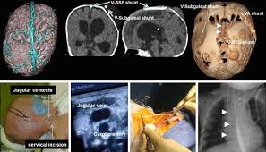 Complex Hydrocephalus Management By Smart Shunt Springerlink