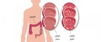 How is the examination performed? Ø¹Ù…Ù„ÙŠØ© ØªÙ†Ø¸ÙŠØ± Ø§Ù„Ù‚ÙˆÙ„ÙˆÙ† Colonoscopy Ø§Ø³Ø¨Ø§Ø¨ Ø·Ø±ÙŠÙ‚Ø© Ø§Ø¬Ø±Ø§Ø¡ Ø§Ù„Ø·Ø¨ÙŠ