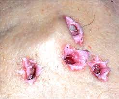 Whereas other forms of traumatic death (eg, gunshot wounds, sharp force injuries) occur under a relatively limited number of circumstances, deaths resulting from blunt force trauma occur in a variety of scenarios. Pathology Outlines Gunshot Wounds