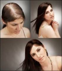 Hair coming out in unusually large clumps in (or out of) the shower is typically giving up your treasured hairstyles that require bleach, heat, and other harsh chemicals could be the key to there are many causes of female hair loss, and it can require specialized treatment plans. 12 Best Female Pattern Baldness Ideas Hair Loss Female Pattern Baldness Hair Loss Women