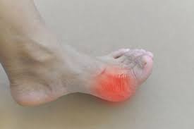 Image result for gout symptoms toe