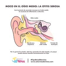 Otorrino de Niños Dra. Iris Rentería