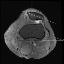 Image result for Patellar Tilt Test