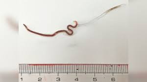 The worms that are swallowed will travel back to your intestine. Doctors Remove Live Worm From Woman S Tonsil Cnn