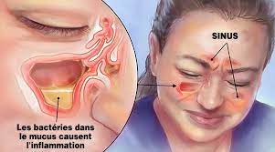 Si votre infection des sinus dure plus de 10 à 14 jours, cela veut dire que vous avez probablement une sinusite bactérienne. Grace A Ces Ingredients Naturels Vous Soulagerez Rapidement Votre Infection Des Sinus