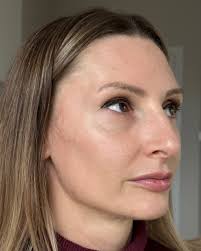 Dzisiaj chcemy pochwalić się tym spektakularnym efektem przed i po 🤩 Nasza  pacjentka miała wykonany zabieg przez naszą kosmetolog @_eliza_155 na  przebarwienia przy użyciu światła szerokopasmowego. Efekt, który widzicie  na zdjęciu PO,