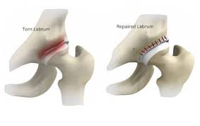 Image result for Hip Labral Tear