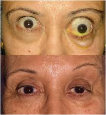 Thyroid Eye Disease Graves Eye Disease Thyroid Orbitopathy Posts Facebook
