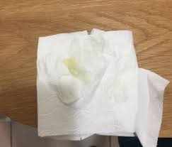 Mucus plug photo 01 mama natural this photo is from a mama who lost her mucus plug at 38 weeks and 1 day. Mucus Plug How Do You Know If You Have Lost It May 2017 Babycenter Australia