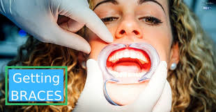 First, the dentist will clean and dry your teeth; Getting Braces What You Need To Know Step By Step