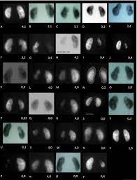Dmsa is the common name for dimercaptosuccinic acid, also known as dimethylsuccinic acid, or disodium monomethanearsonate. Does Severity Of Renal Scarring On Dmsa Scan Predict Abnormalities In Creatinine Clearance Urology